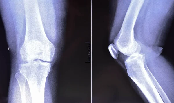 X-ray of the knee joints, an image of the knee bones on an X-ray.