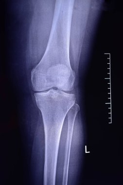 Diz ekleminde artrosis. X-ray resmi.