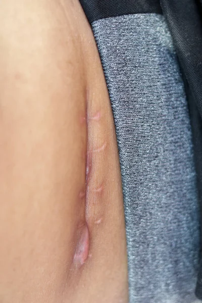 ケロイドの傷胃の外科的傷 — ストック写真