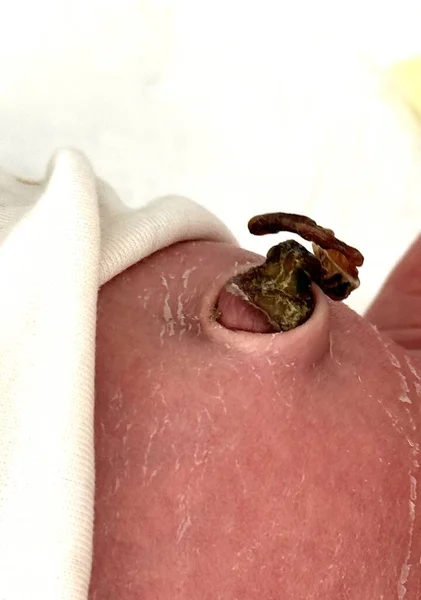 Dry Umbilical Cord Newborn — Stock Photo, Image