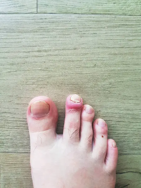 İncinmiş derisi ve zarar görmüş ayak tırnaklarıyla ahşap bir zeminde duran insan ayağının detaylı bir yakın çekimi. Görüntü, tırnak enfeksiyonu veya yaralanma gibi sağlık sorunlarını vurguluyor.