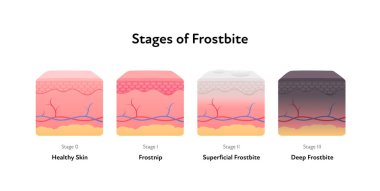 Soğuk ısırması anatomik bilgi afişi. Vektör düz tıbbi illüstrasyon. Hipotermi hastalığının aşamaları. Sağlıklı, soğuk, yüzeysel ve derin deri tabakası. Sağlık hizmetleri dermatolojisi için tasarım