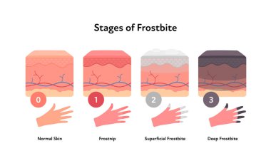 Soğuk ısırığı anatomik bilgisi. Vektör düz sağlık hizmeti çizimi. Hipotermi ve rüzgar yanığı aşamaları. Deri katmanları, parmakları ve sahne numarası olan eller. Dermatoloji için tasarım