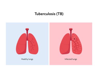 Tuberculosis disease concept. Vector flat healthcare illustration. Healthy and infected lung on red and blue background. Design element for health care, education, pulmonology