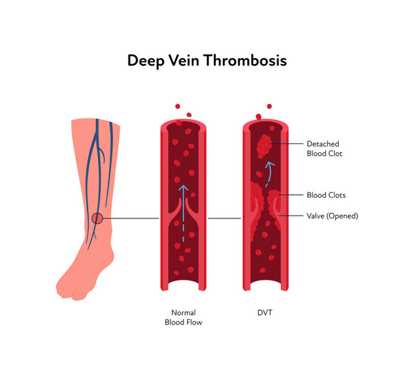 Тромбоз глубоких вен для инфографики здравоохранения. Векторная плоская иллюстрация символов. Диагностика и лечение сосудистых заболеваний. Здоровые человеческие вены и ДВТ. Дизайн для здравоохранения, образования