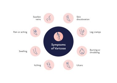 Sağlık bilgileri için varis hastalığı var. Vektör düz çizelge çizimi. Vasküler hastalık teşhisi ve tedavisi. Semptomlar. Eğitim için tasarım