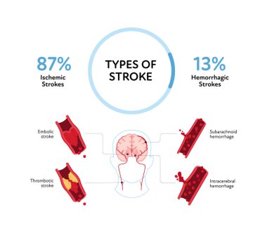 Sağlık bilgileri için beyin nöral hastalıkları. Vektör düz çizim. Embolik, trombotik, subaraknoid ve intraserebral kanama. Olasılık yüzde yüz. Sağlık hizmetleri için tasarım