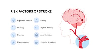 Sağlık bilgileri için beyin nöral hastalıkları. Vektör düz çizim. Felç posteri ve ikon setinin risk faktörleri. Sağlık hizmetleri için tasarım