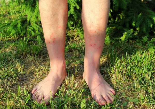 Мужские Ноги Сильно Укушены Комарами Мошками Живущими Траве Летом Раны — стоковое фото