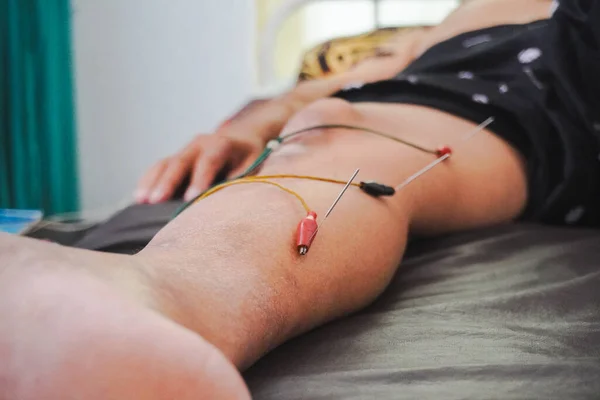 Closeup needles on patient body stimulated by electric. Acupuncture, Chinese alternative medicine.