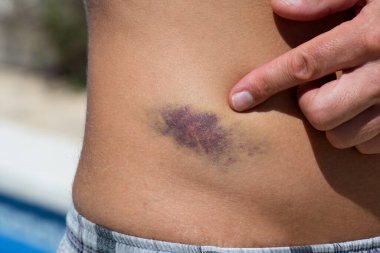 İnsan vücudundaki büyük çürüklerin ayrıntıları.