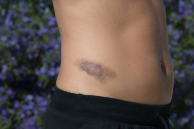 İnsan vücudundaki büyük çürüklerin ayrıntıları.