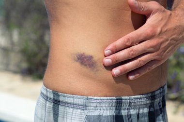 İnsan vücudundaki büyük çürüklerin ayrıntıları.