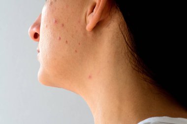 Derisi ve sivilcesi sorunlu kadın, yakın plan.