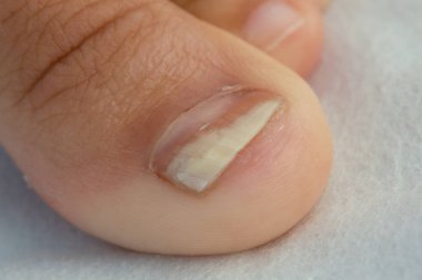 Tırnak mantarı enfeksiyonu olan bir parmağın görüntüsünü kapat.