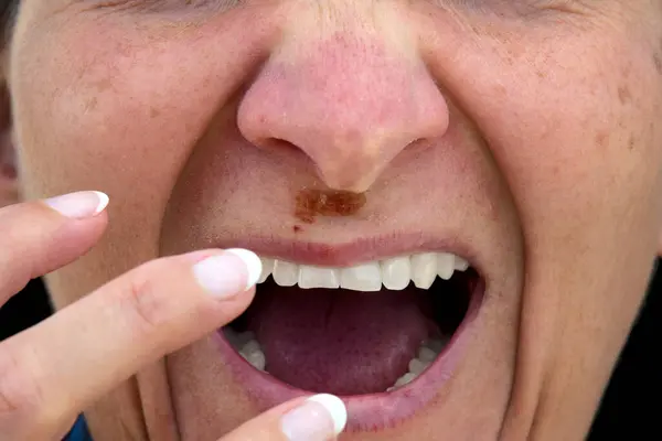 Woman with problematic skin, detail of herpes. Medical problem.