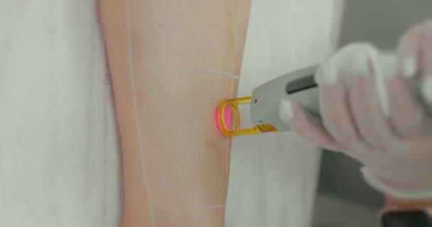 Close Footage Female Client Leg Receiving Pulses Laser Light Destroying — 비디오