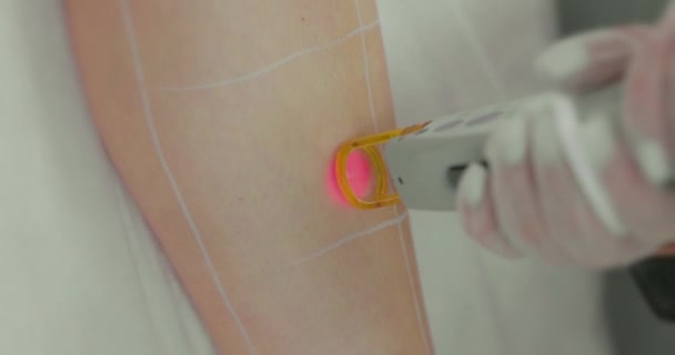 Close Footage Female Client Leg Receiving Pulses Laser Light Destroying — Stock Video