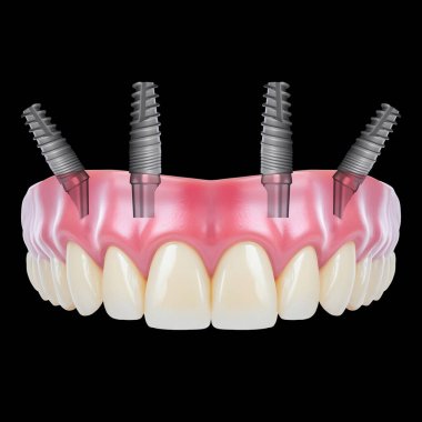 Diş hekimliği ve çene cerrahisinde, diş implantı olmadan çene implantları üzerinde tam kemerli diş protezinden önce ve sonra, endosteal diş implantları kullanarak.