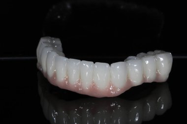 Diş hekimliği ve çene cerrahisinde, diş implantı olmadan çene implantları üzerinde tam kemerli diş protezinden önce ve sonra, endosteal diş implantları kullanarak.