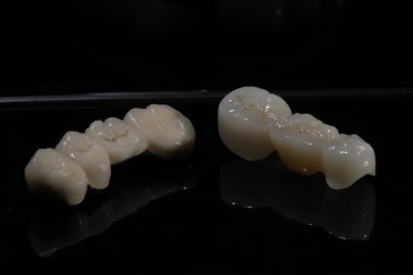 Diş implantı ameliyatı ve diş implantı destekli köprü protezi. Vida zirkonyum porselenden yapılmış porselen kaplama onarım ile korunan tedavi.