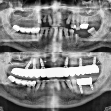 Diş hekimliği ve çene cerrahisinde, diş implantı olmadan çene implantları üzerinde tam kemerli diş protezinden önce ve sonra, endosteal diş implantları kullanarak.