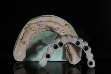 Ağız cerrahisi ve diş hekimliğinde tam kemerli diş implantı tedavisi. Hepsi tam çene porselen diş protezi ile X tedavisi.