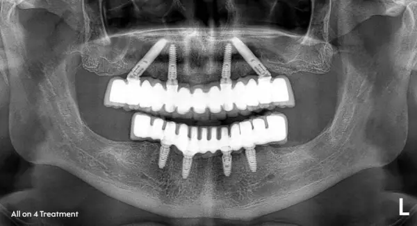 Diş hekimliği ve çene cerrahisinde, diş implantı olmadan çene implantları üzerinde tam kemerli diş protezinden önce ve sonra, endosteal diş implantları kullanarak.