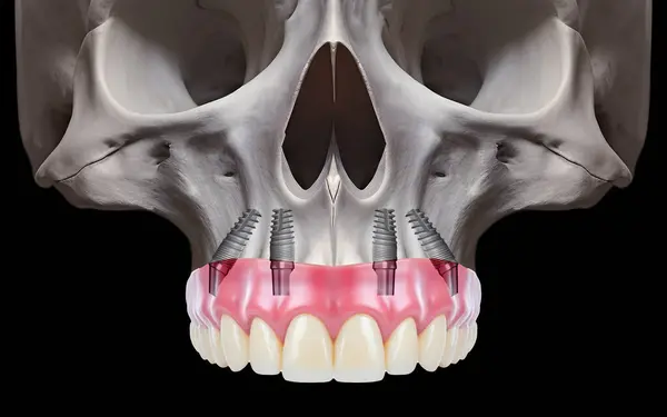 Diş hekimliği ve çene cerrahisinde, diş implantı olmadan çene implantları üzerinde tam kemerli diş protezinden önce ve sonra, endosteal diş implantları kullanarak.