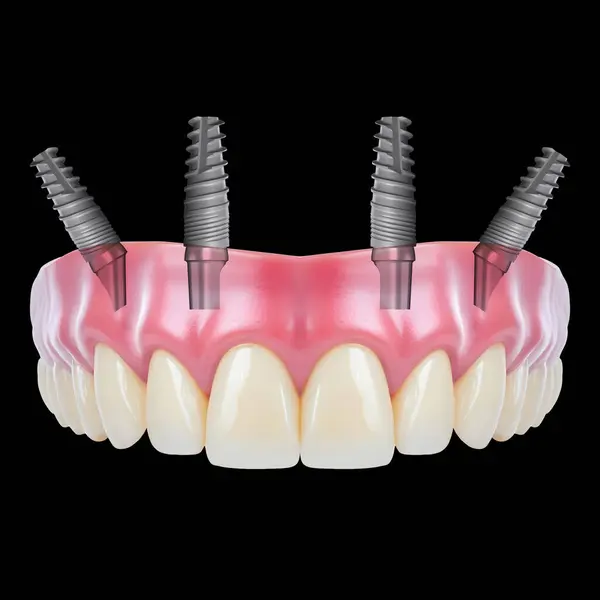 Diş hekimliği ve çene cerrahisinde, diş implantı olmadan çene implantları üzerinde tam kemerli diş protezinden önce ve sonra, endosteal diş implantları kullanarak.