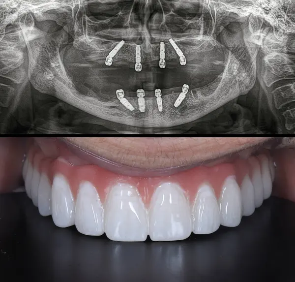 Diş hekimliği ve çene cerrahisinde, diş implantı olmadan çene implantları üzerinde tam kemerli diş protezinden önce ve sonra, endosteal diş implantları kullanarak.