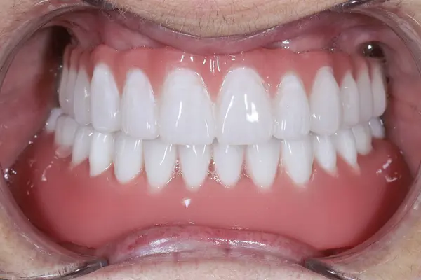 Diş hekimliği ve çene cerrahisinde, diş implantı olmadan çene implantları üzerinde tam kemerli diş protezinden önce ve sonra, endosteal diş implantları kullanarak.