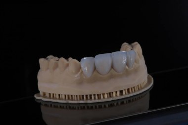 Işık ileten lamine porselen kaplamalar. Gülümseme tasarımı ve bilgisayar destekli çene modeli diş estetiği tedavilerinde kullanılır. Gülümse. diş kaplamaları. 