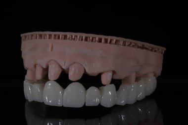 Dolgun ağızlı protez porselen kaplamalar zirkonyum malzemesinden yapılmış. Dişçi gülümseme tasarımı ve bilgisayar destekli çene modeli.