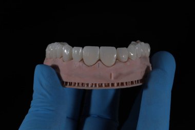 Diş estetiği tedavisinde estetik ve çiğneme işlevleri için zirkonyum porselen kaplamalı tam ağızlı diş restorasyonu. Gülümse..