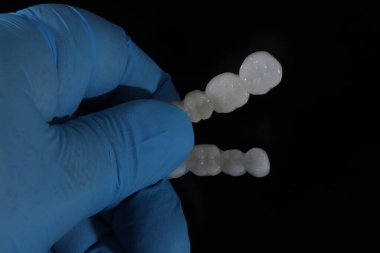 Dolgun ağızlı protez porselen kaplamalar zirkonyum malzemesinden yapılmış. Dişçi gülümseme tasarımı ve bilgisayar destekli çene modeli.