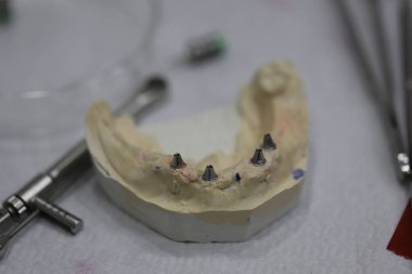 Ağızdan alınan implant izleri ve diş hekimliğinde implant analogları. Hepsi X 'e diş implantı tedavisi.