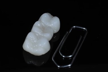 Köprü kaplaması protez tedavisi diş estetik dişlerinde eksik diş için. Zirkonyum porselen köprü tedavisi ve E-max porselen diş kaplaması.