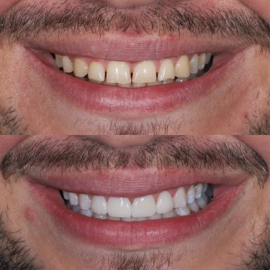 Restoration of discolored, broken, and worn teeth with E-max and zirconium laminate veneers in cosmetic dentistry. Includes before and after dental treatment and smile design therapy. clipart