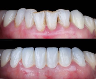Diş hekimliğinde estetik gülümseme tasarımı tedavisi. Kaplamalı diş tedavisi, diş implantları ve porselen kaplamalar. Gülümse makyaj ve diş bakımı öncesi ve sonrası. 