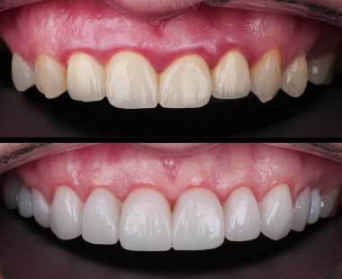 Diş hekimliğinde estetik gülümseme tasarımı tedavisi. Kaplamalı diş tedavisi, diş implantları ve porselen kaplamalar. Gülümse makyaj ve diş bakımı öncesi ve sonrası. 