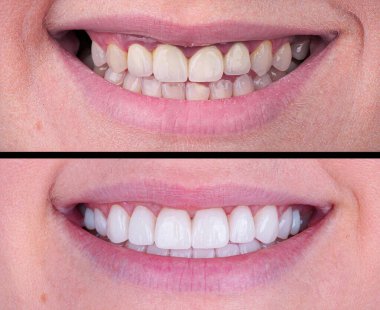 Diş hekimliğinde estetik gülümseme tasarımı tedavisi. Kaplamalı diş tedavisi, diş implantları ve porselen kaplamalar. Gülümse makyaj ve diş bakımı öncesi ve sonrası. 