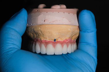 Diş implantı cerrahisi kullanılarak All-on-X ve All-on-4 tedavi prosedürü ile ilgili tam kemerli porselen destekli çene protezi.