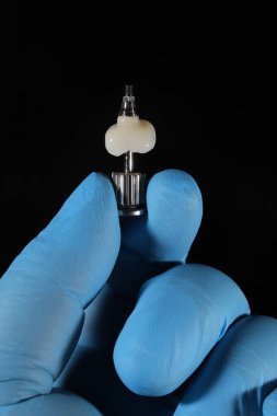 Porselen E-Max ya da zirkonyum protez tedavisi, diş cerrahisi yoluyla kemik yerleştirilmiş diş implantları tarafından destekleniyor. Gülümse tasarım tedavisi ve gülümseme makyajı.