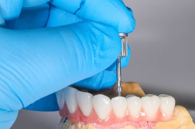 Diş cerrahisi sırasında kemik nakli ve diş implantı uygulanmış. Diş implantı anahtarıyla vidalanmış diş protezi. Gülümse, baştan yarat, tek başına