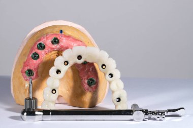 Mavi eldiven takan bir dişçinin tam kemerli diş protezi. İmplant destekli porselen, tam kemerli diş protezi. Vidalı implant diş protezi. Gülümse tasarımı.