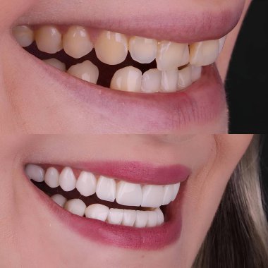 Diş hekimliğinde estetik gülümseme tasarımı tedavisi. Kaplamalı diş tedavisi, diş implantları ve porselen kaplamalar. Gülümse makyaj ve diş bakımı öncesi ve sonrası. 