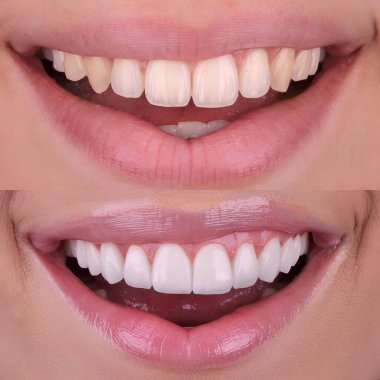 Diş hekimliğinde estetik gülümseme tasarımı tedavisi. Kaplamalı diş tedavisi, diş implantları ve porselen kaplamalar. Gülümse makyaj ve diş bakımı öncesi ve sonrası. 