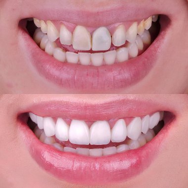 Diş hekimliğinde estetik gülümseme tasarımı tedavisi. Kaplamalı diş tedavisi, diş implantları ve porselen kaplamalar. Gülümse makyaj ve diş bakımı öncesi ve sonrası. 