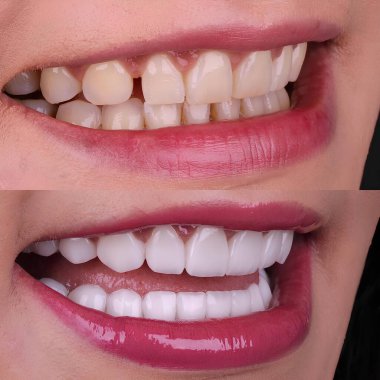 Diş hekimliğinde estetik gülümseme tasarımı tedavisi. Kaplamalı diş tedavisi, diş implantları ve porselen kaplamalar. Gülümse makyaj ve diş bakımı öncesi ve sonrası. 